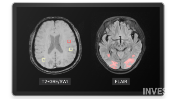▲뉴로핏 아쿠아 AD (출처 = 뉴로핏)